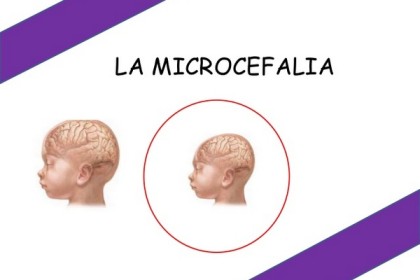 microcefalia-icc-4-638